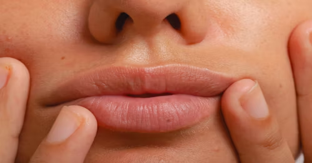 Lip Flip Before and After